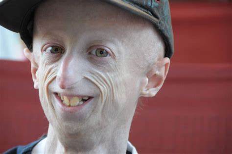 Murió a los 28 años, el italiano que visibilizó el síndrome de envejecimiento prematuro
