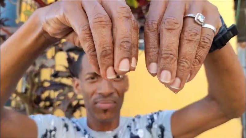 Hombre con sudoración excesiva en sus manos clama ayuda